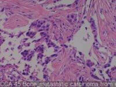 Hematoxylin & Eosin Stain: Human Lung Tissue MicroArray (Cancer metastasis) [NBP2-30222] -  45. Bone metastatic carcinoma from #35