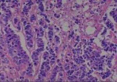 Hematoxylin & Eosin Stain: Human Lung Tissue MicroArray (Cancer metastasis) [NBP2-30222] - 46. Lymph node metastatic carcinoma from #36