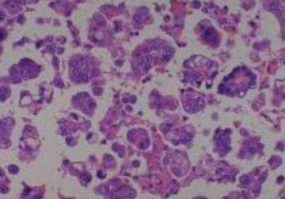 Hematoxylin & Eosin Stain: Human Lung Tissue MicroArray (Cancer metastasis) [NBP2-30222] -  47. Lymph node metastatic carcinoma from #37