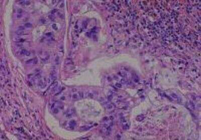 Hematoxylin & Eosin Stain: Human Lung Tissue MicroArray (Cancer metastasis) [NBP2-30222] -  48. Lymph node metastatic carcinoma from #38