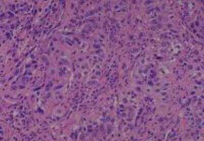 Hematoxylin & Eosin Stain: Human Lung Tissue MicroArray (Cancer metastasis) [NBP2-30222] - 50. Soft tissue metastatic carcinoma from #40