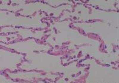 Hematoxylin & Eosin Stain: Human Lung Tissue MicroArray (Cancer metastasis) [NBP2-30222] - 51. Lung normal lung (adjacent to cancer, match of #8