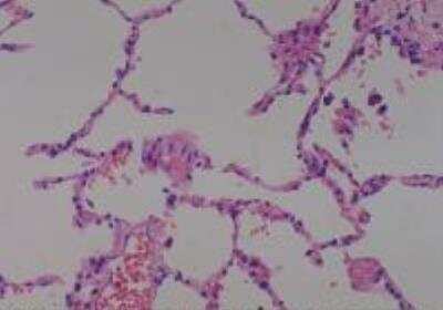 Hematoxylin & Eosin Stain: Human Lung Tissue MicroArray (Cancer metastasis) [NBP2-30222] -  52. Lung normal lung (adjacent to cancer, match of #12)