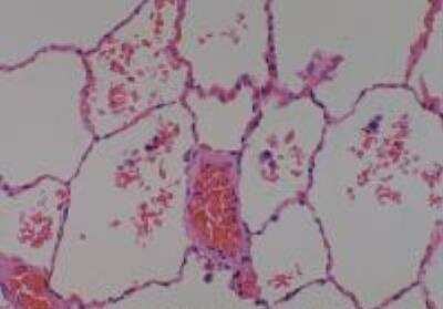 Hematoxylin & Eosin Stain: Human Lung Tissue MicroArray (Cancer metastasis) [NBP2-30222] - 53. Lung normal lung (adjacent to cancer, match of #17)