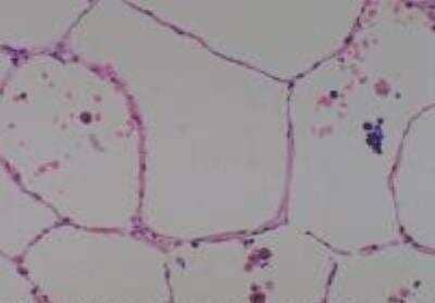 Hematoxylin & Eosin Stain: Human Lung Tissue MicroArray (Cancer metastasis) [NBP2-30222] -  54. Lung normal lung (adjacent to cancer, match of #20)