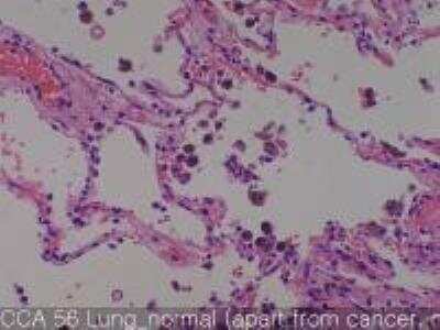 Hematoxylin & Eosin Stain: Human Lung Tissue MicroArray (Cancer metastasis) [NBP2-30222] - 56.Lung normal lung (apart from cancer, match of #1)