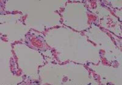 Hematoxylin & Eosin Stain: Human Lung Tissue MicroArray (Cancer metastasis) [NBP2-30222] - 59. Lung normal lung (apart from cancer, match of #35)