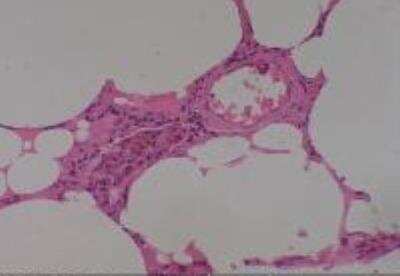 Hematoxylin & Eosin Stain: Human Lung Tissue MicroArray (Cancer metastasis) [NBP2-30222] - 58.Lung normal lung (apart from cancer, match of #23)