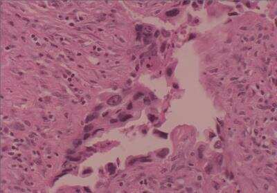 Hematoxylin & Eosin Stain: Human Lung Tissue MicroArray (Cancer metastasis) [NBP2-30222] - 49. Bone, femur metastatic carcinoma from #39