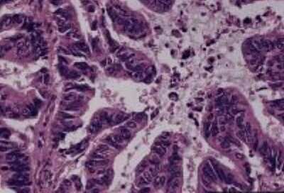 Hematoxylin & Eosin Stain: Lung Tissue Slides (Adenocarcinoma) [NBP2-30279] - adenocarcinoma, moderated differentiated type, papillary  Age/Sex : 62/M