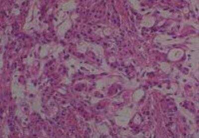 Hematoxylin & Eosin Stain: Human Metastatic Cancer to Ovary Tissue MicroArray [NBP2-30286] - 108. Ovary Metastatic Adenocarcinoma