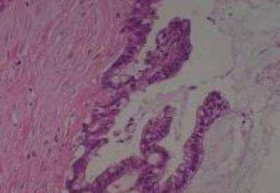 Hematoxylin & Eosin Stain: Human Metastatic Cancer to Ovary Tissue MicroArray [NBP2-30286] -  116. Ovary Metastatic Adenocarcinoma