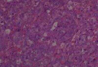 Hematoxylin & Eosin Stain: Human Metastatic Cancer to Ovary Tissue MicroArray [NBP2-30286] - 19. Ovary Metastatic Adenocarcinoma