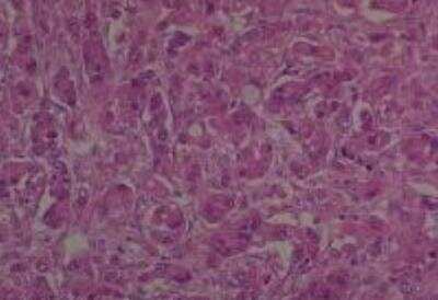 Hematoxylin & Eosin Stain: Human Metastatic Cancer to Ovary Tissue MicroArray [NBP2-30286] -  120. Ovary Metastatic Signet Ring Cell Carcinoma