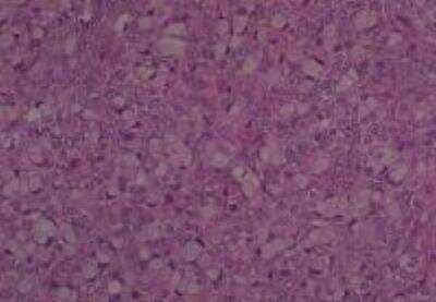 Hematoxylin & Eosin Stain: Human Metastatic Cancer to Ovary Tissue MicroArray [NBP2-30286] -  121. Ovary Metastatic Signet Ring Cell Carcinoma