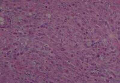 Hematoxylin & Eosin Stain: Human Metastatic Cancer to Ovary Tissue MicroArray [NBP2-30286] - 122. Ovary Metastatic Adenocarcinoma