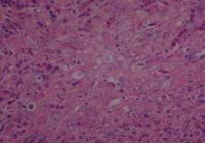 Hematoxylin & Eosin Stain: Human Metastatic Cancer to Ovary Tissue MicroArray [NBP2-30286] - 125. Ovary Metastatic Signet Ring Cell Carcinoma