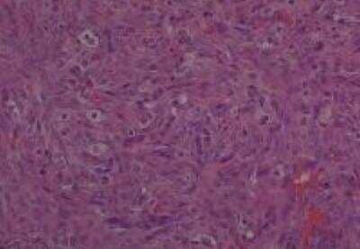 Hematoxylin & Eosin Stain: Human Metastatic Cancer to Ovary Tissue MicroArray [NBP2-30286] -  130. Ovary Metastatic Adenocarcinoma