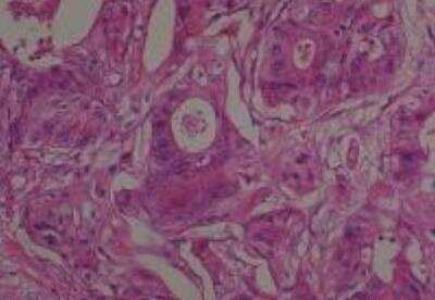 Hematoxylin & Eosin Stain: Human Metastatic Cancer to Ovary Tissue MicroArray [NBP2-30286] - 139. Ovary Metastatic Adenocarcinoma