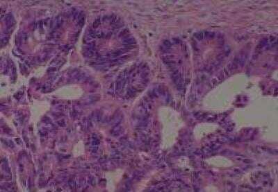 Hematoxylin & Eosin Stain: Human Metastatic Cancer to Ovary Tissue MicroArray [NBP2-30286] - 145. Ovary Metastatic Adenocarcinoma