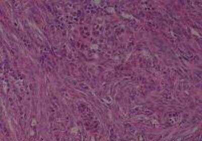 Hematoxylin & Eosin Stain: Human Metastatic Cancer to Ovary Tissue MicroArray [NBP2-30286] - 152. Ovary Metastatic Adenocarcinoma