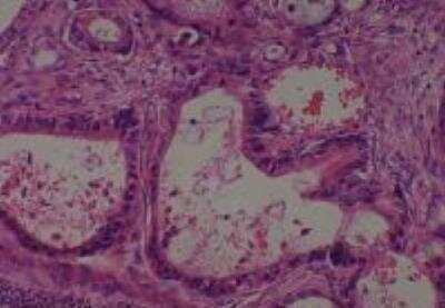 Hematoxylin & Eosin Stain: Human Metastatic Cancer to Ovary Tissue MicroArray [NBP2-30286] - 153. Ovary Metastatic Adenocarcinoma