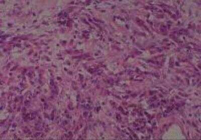 Hematoxylin & Eosin Stain: Human Metastatic Cancer to Ovary Tissue MicroArray [NBP2-30286] -  155. Ovary Metastatic Adenocarcinoma