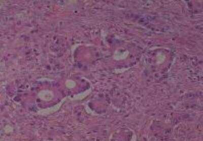 Hematoxylin & Eosin Stain: Human Metastatic Cancer to Ovary Tissue MicroArray [NBP2-30286] -  159. Ovary Metastatic Signet Ring Cell Carcinoma