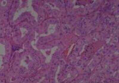 Hematoxylin & Eosin Stain: Human Thyroid Tissue MicroArray (Cancer) [NBP2-30317] -  02. Thyroid Papillay Carinoma