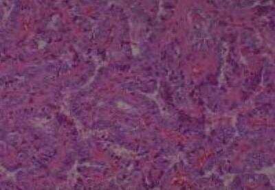 Hematoxylin & Eosin Stain: Human Thyroid Tissue MicroArray (Cancer) [NBP2-30317] - Thyroid Papillary Carcinoma