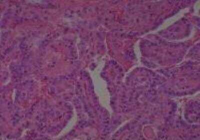 Hematoxylin & Eosin Stain: Human Thyroid Tissue MicroArray (Cancer) [NBP2-30317] - 05. Thyroid Papillary Carcinoma