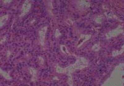 Hematoxylin & Eosin Stain: Human Thyroid Tissue MicroArray (Cancer) [NBP2-30317] - 08. Thyroid Papillary Carcinoma