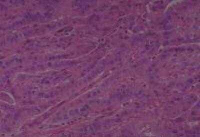 Hematoxylin & Eosin Stain: Human Thyroid Tissue MicroArray (Cancer) [NBP2-30317] - 10. Thyroid Papillary Carcinoma