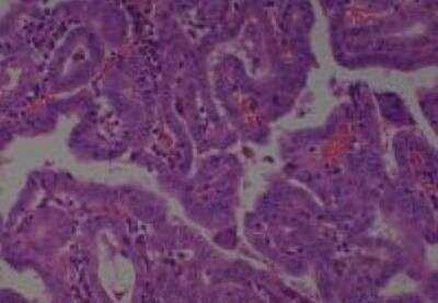 Hematoxylin & Eosin Stain: Human Thyroid Tissue MicroArray (Cancer) [NBP2-30317] - 12. Thyroid Papillary Carcinoma