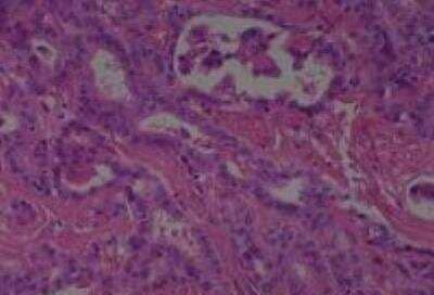 Hematoxylin & Eosin Stain: Human Thyroid Tissue MicroArray (Cancer) [NBP2-30317] -  14. Thyroid Papillary Carcinoma