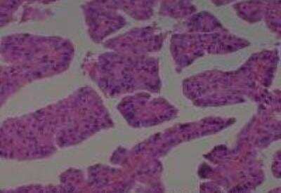 Hematoxylin & Eosin Stain: Human Thyroid Tissue MicroArray (Cancer) [NBP2-30317] -  21. Thyroid Papillary Carcinoma