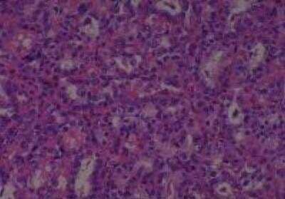 Hematoxylin & Eosin Stain: Human Thyroid Tissue MicroArray (Cancer) [NBP2-30317] - 29. Thyroid papillary carcinoma