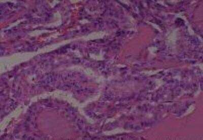 Hematoxylin & Eosin Stain: Human Thyroid Tissue MicroArray (Cancer) [NBP2-30317] -  30. Thyroid Papillary Carcinoma