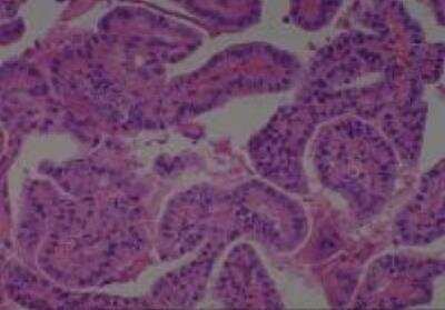 Hematoxylin & Eosin Stain: Human Thyroid Tissue MicroArray (Cancer) [NBP2-30317] -  31. Thyroid Papillary Carcinoma