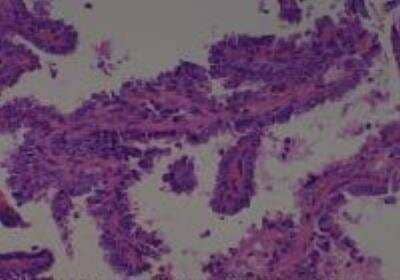 Hematoxylin & Eosin Stain: Human Thyroid Tissue MicroArray (Cancer) [NBP2-30317] -  37. Thyroid papilary carcinoma