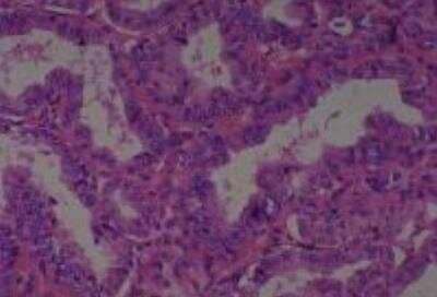 Hematoxylin & Eosin Stain: Human Thyroid Tissue MicroArray (Cancer) [NBP2-30317] - 43. Thyroid papillary carcinoma