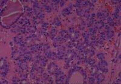 Hematoxylin & Eosin Stain: Human Thyroid Tissue MicroArray (Cancer) [NBP2-30317] - 44. Thyroid, follicular carcinoma