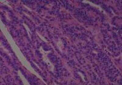 Hematoxylin & Eosin Stain: Human Thyroid Tissue MicroArray (Cancer) [NBP2-30317] -  48. Thyroid Papillary Carcinoma