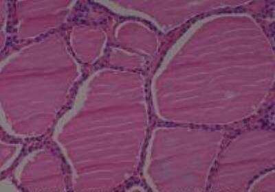 Hematoxylin & Eosin Stain: Human Thyroid Tissue MicroArray (Cancer) [NBP2-30317] -  53. Thyroid, benign thyroid tissue