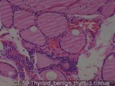 Hematoxylin & Eosin Stain: Human Thyroid Tissue MicroArray (Cancer) [NBP2-30317] - 59. Thyroid benign thyroid tissue