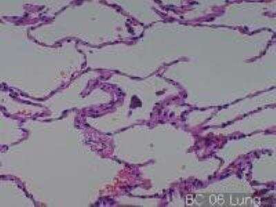 Hematoxylin & Eosin Stain: Human Various Tissue MicroArray (Cancer) [NBP2-30233] - 06. Lung