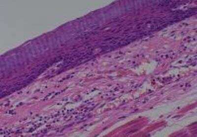 Hematoxylin & Eosin Stain: Human Various Tissue MicroArray (Cancer) [NBP2-30233] -  12. Esophagus