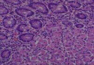 Hematoxylin & Eosin Stain: Human Various Tissue MicroArray (Cancer) [NBP2-30233] - 14. Stomach, fundus