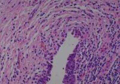 Hematoxylin & Eosin Stain: Human Various Tissue MicroArray (Cancer) [NBP2-30233] -  20. Urinary bladder