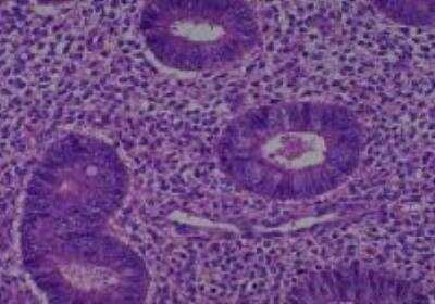 Hematoxylin & Eosin Stain: Human Various Tissue MicroArray (Cancer) [NBP2-30233] - 24. Endometrium